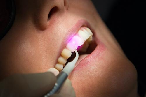 Woman patient getting laser dentistry treatment, centerville oh
