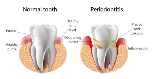 Graphic of a normal tooth and a tooth with periodontitis, centerville oh
