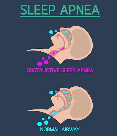 Graphic describing sleep apnea, centerville oh