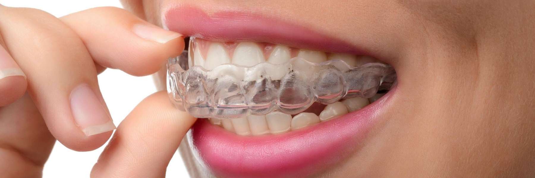 Invisalign going into teeth, centerville oh