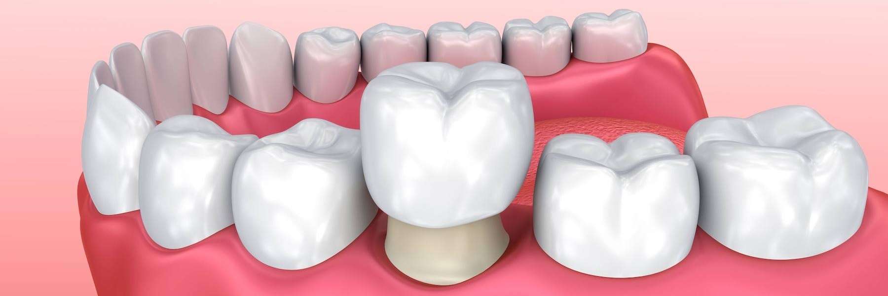 Crown being placed on tooth, centerville oh