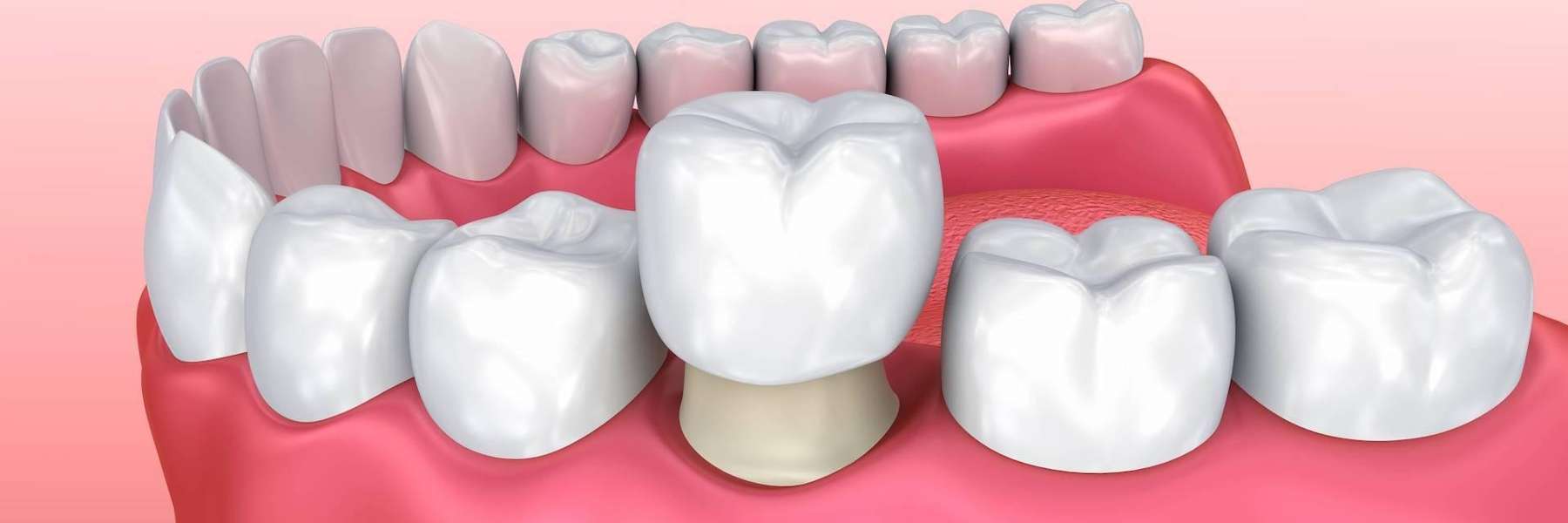 CEREC same-day crown being placed on a tooth, centerville oh