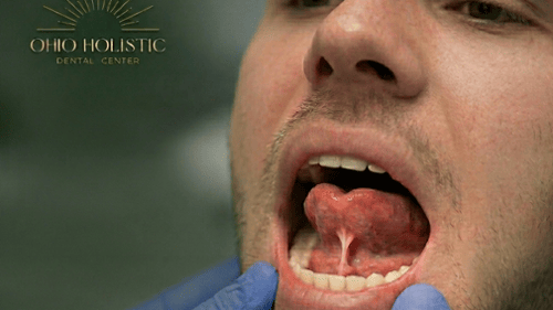  tongue position, tongue tie, during dental examination for airway assessment