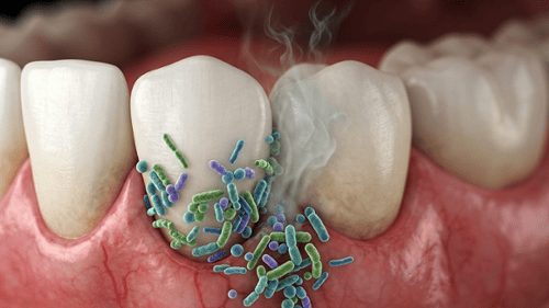 3D illustration of bacteria and odor around teeth and gumline causing bad breath