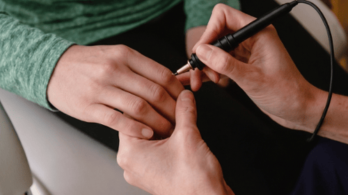  using an electro-acupuncture probe on a patient's hand during biocompatibility testing