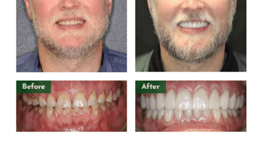 Full mouth Rehabilitation, broken down teeth, full mouth restore 