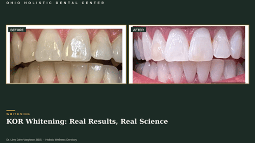 Dental Whitening Before & After Photos in Office Whitening 