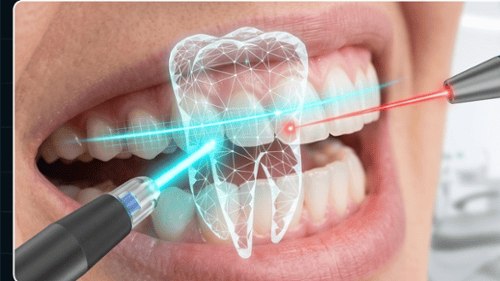 Dental lasers minimize the need for needles, drills, and traditional scalpels, drastically reducing 