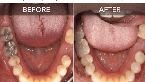 Before and after showing silver amalgam fillings replaced with tooth-colored composite restorations