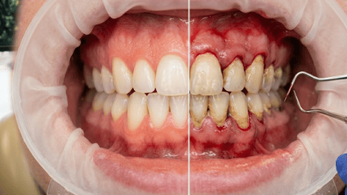 show the difference between healthy and non healthy gums 