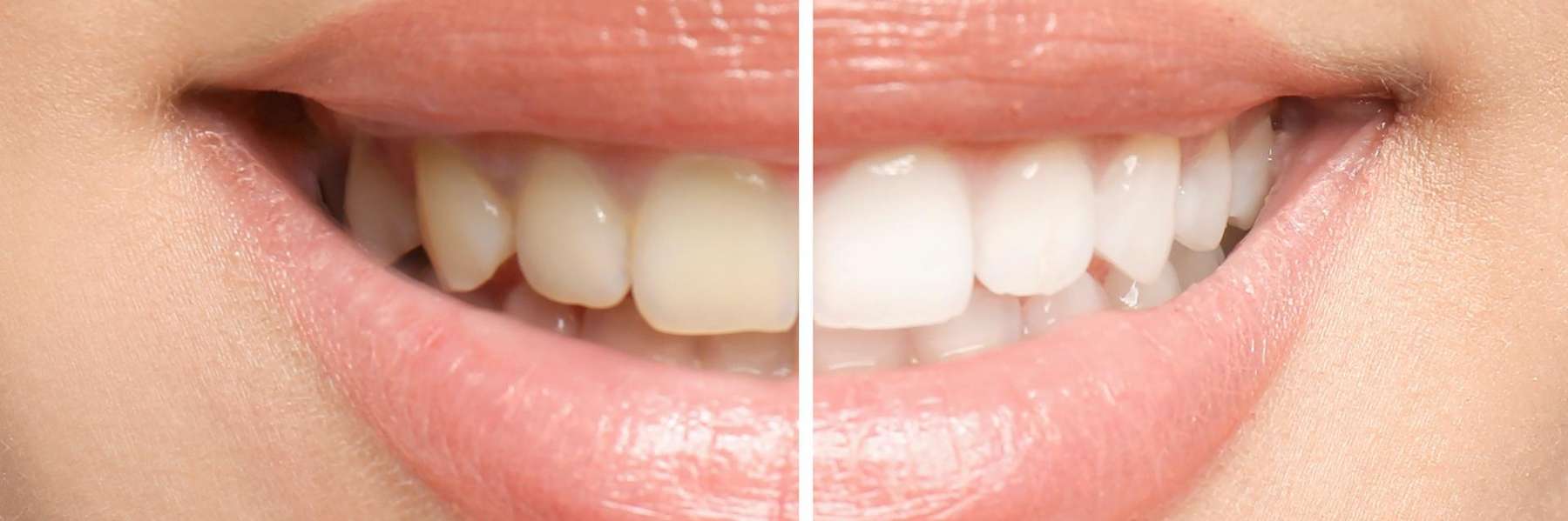 Before and after image of teeth using teeth whitening, centerville oh