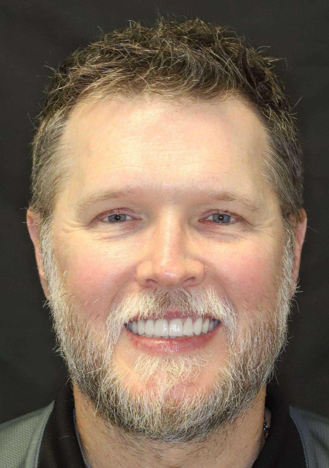 Full face picture of man after full mouth reconstruction, centerville oh