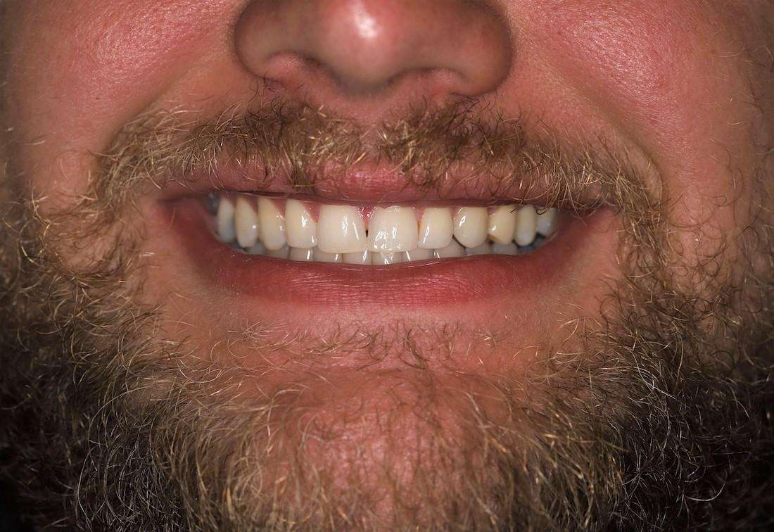 Close up of mans mouth after invisalign, centerville oh