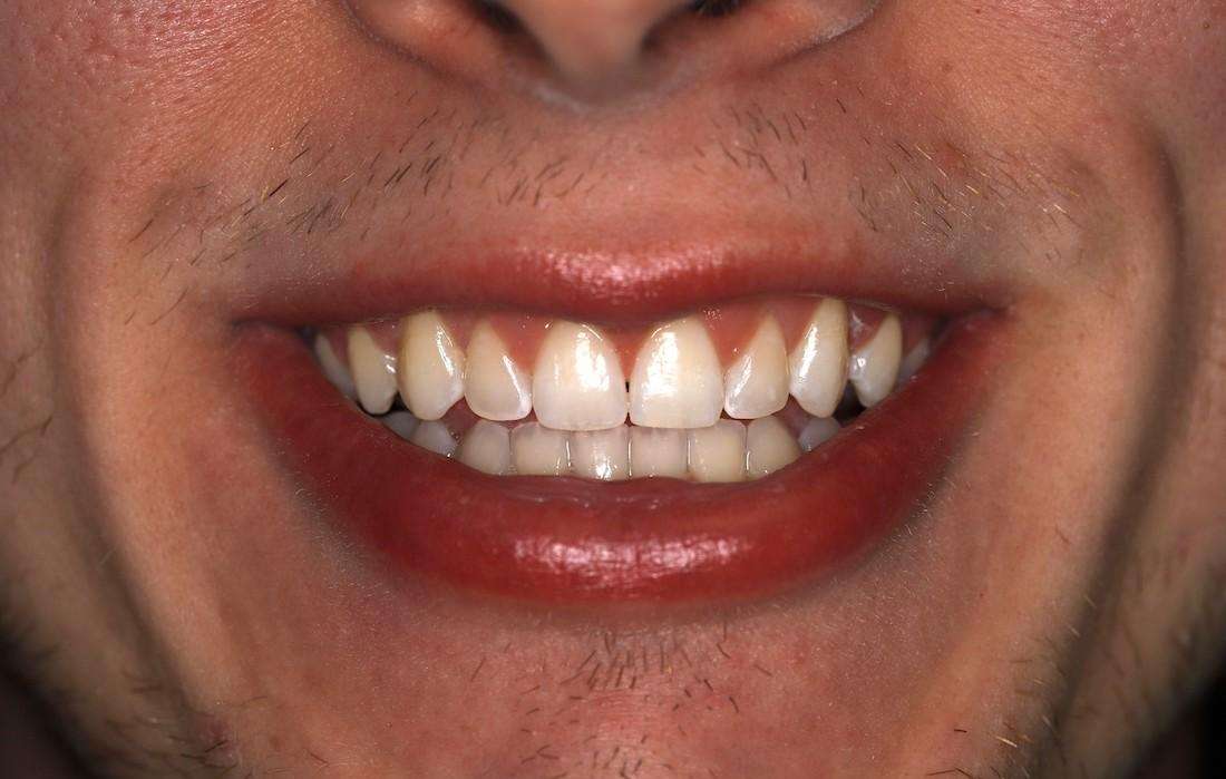 Close up of mans mouth after invisalign, centerville oh
