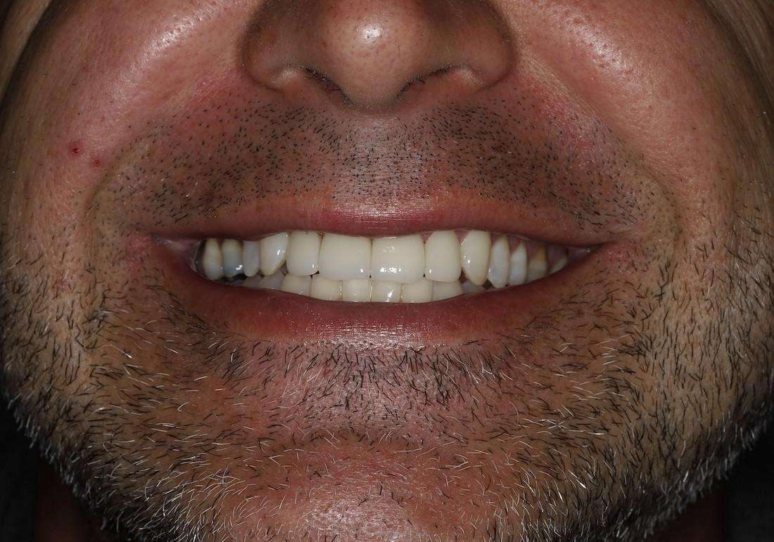 Close up of mans mouth after kor whitening and anterior crowns, centerville oh