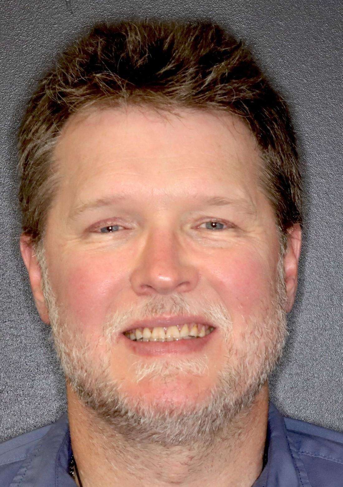 Full face picture of man before full mouth reconstruction, centerville oh