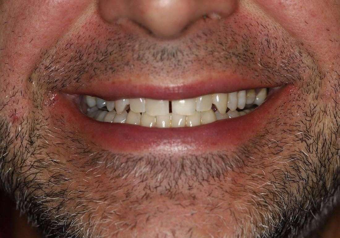 Close up of mans mouth before kor whitening and anterior crowns, centerville oh