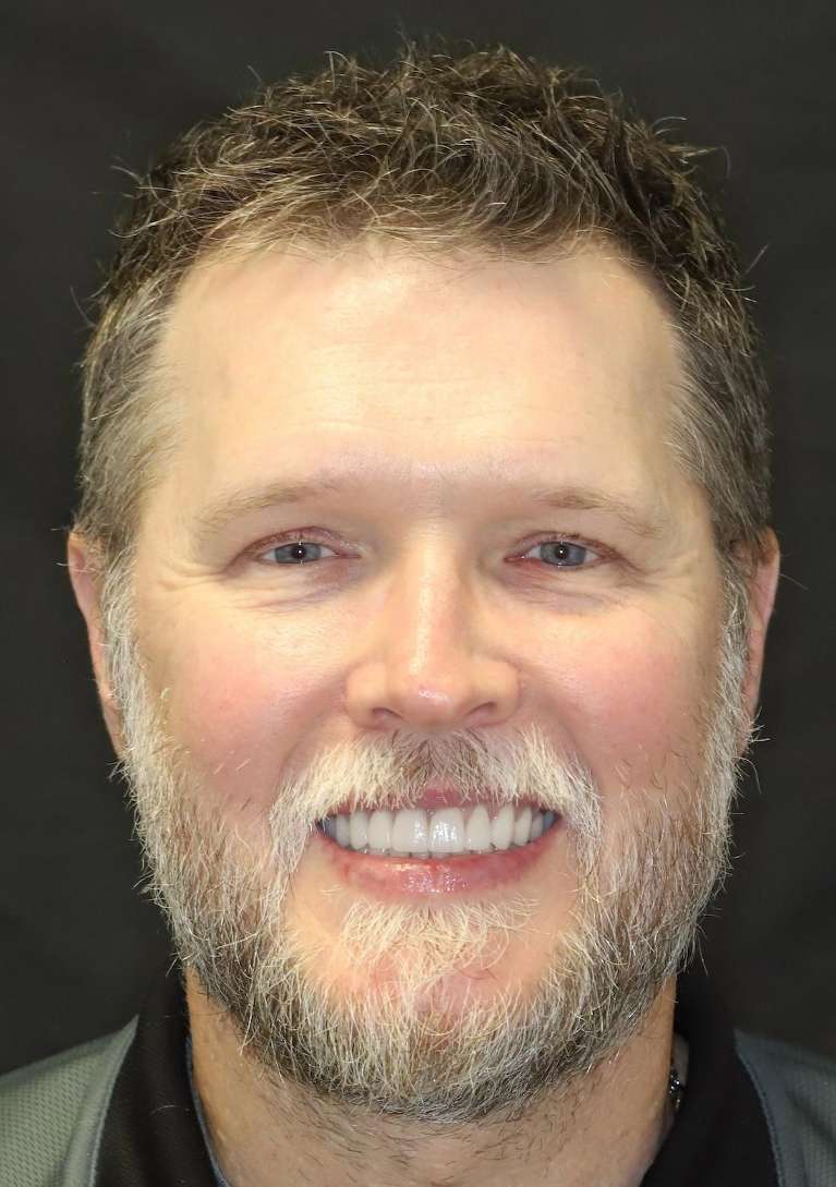 Full-Mouth-Reconstruction-After-Image