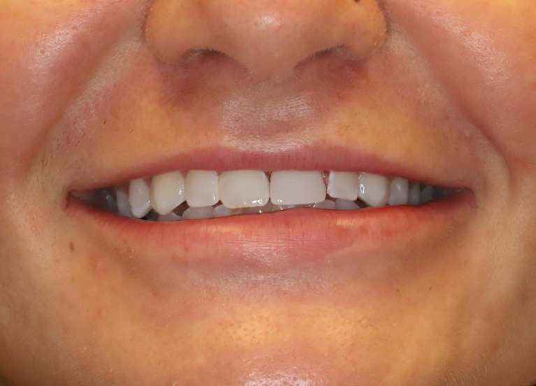 Close up of mans mouth after implant restoration, centerville oh