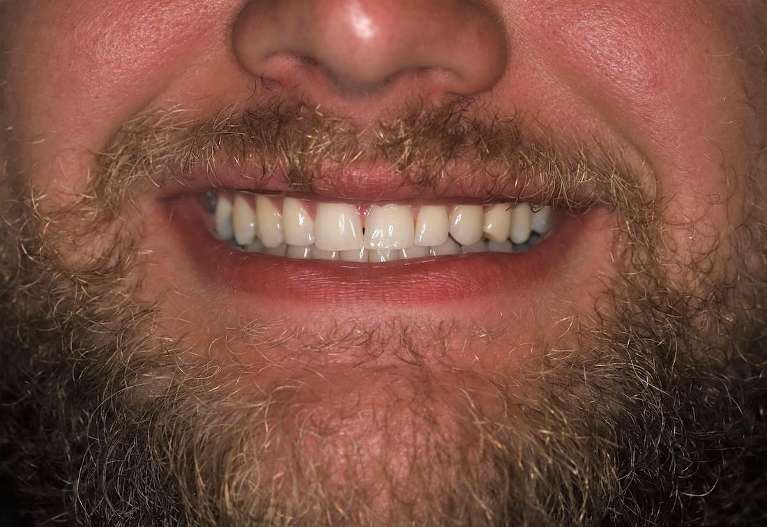 Invisalign-After-Image