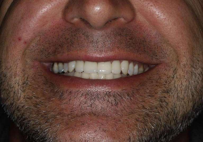 Kor-Whitening-and-Anterior-Crowns-After-Image