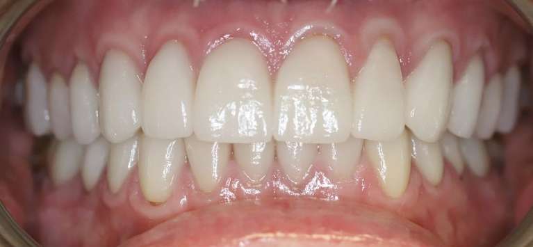 Close up of teeth after full mouth reconstruction, centerville oh