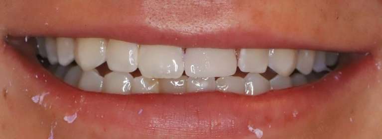 Secondary view of close up of mans mouth after implant restoration, centerville oh