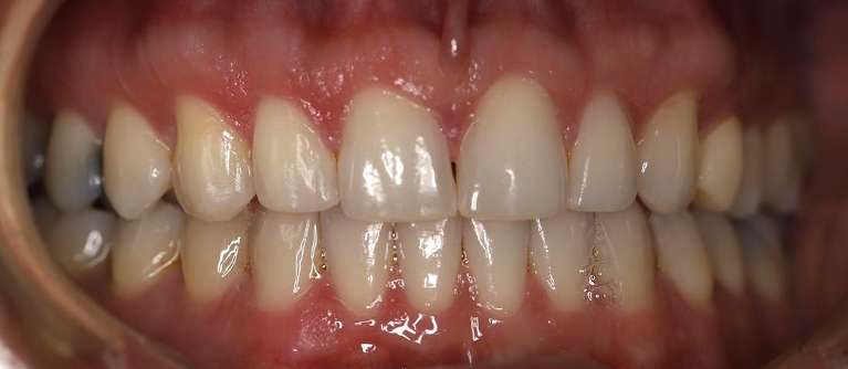 Secondary view of close up of mans mouth after invisalign, centerville oh