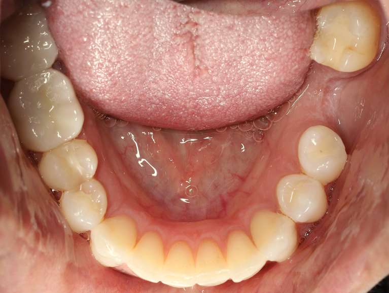 Safe-Mercury-Amalgam-Removal-Technique-SMART-After-Image