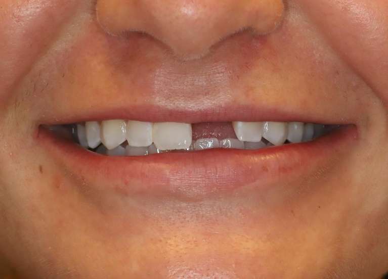 Close up of mans mouth before implant restoration, centerville oh