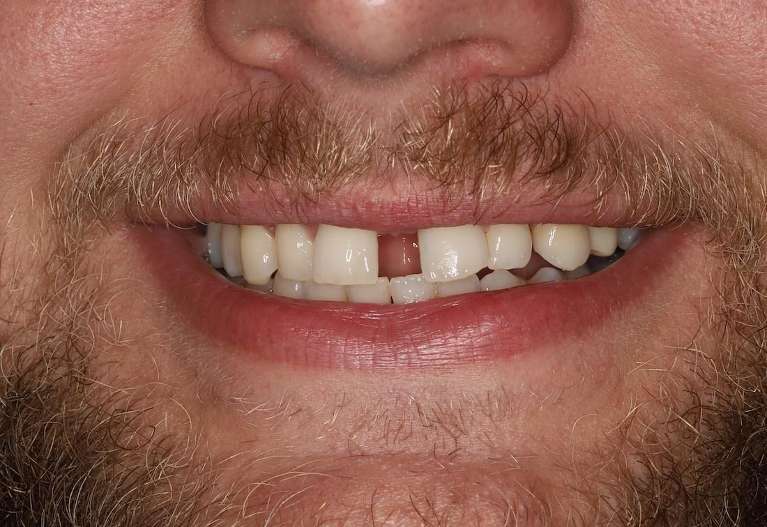 Invisalign-Before-Image