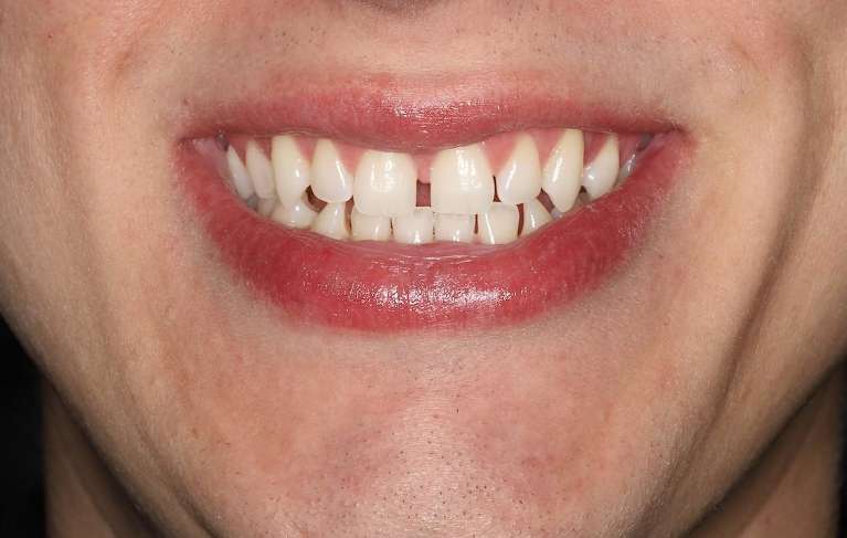 Invisalign-Before-Image