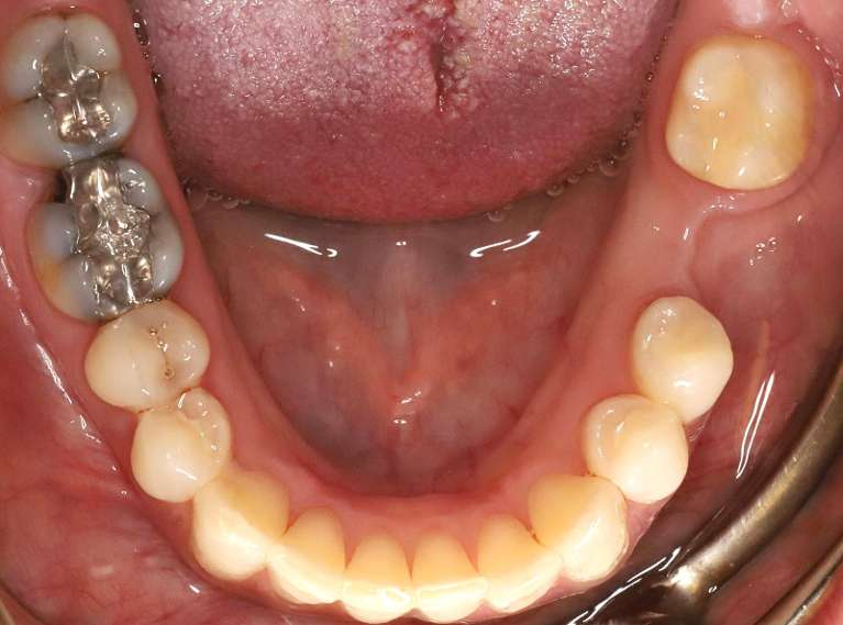 Safe-Mercury-Amalgam-Removal-Technique-SMART-Before-Image