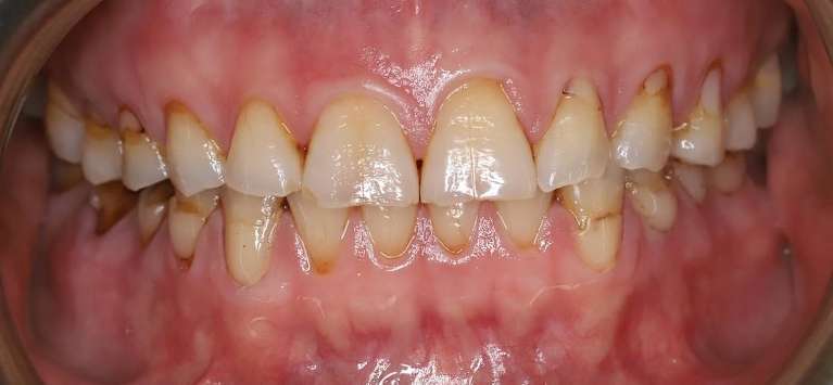 Close of teeth before full mouth reconstruction, centerville oh