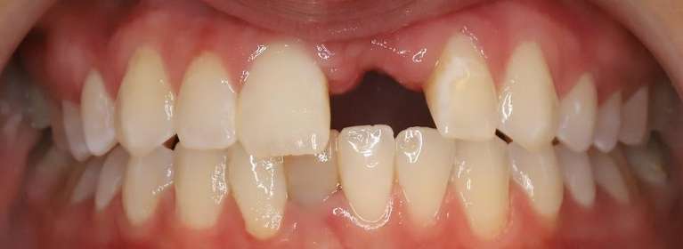 Secondary view of close up of mans mouth before implant restoration, centerville oh