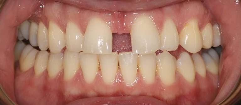 Secondary view of close up of mans mouth before invisalign, centerville oh